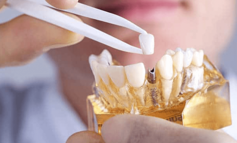 Are Dental Implants Common in Adelaide?