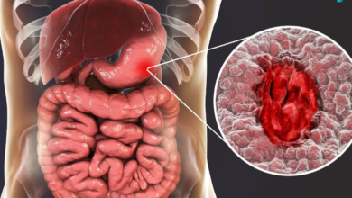 How to deal with peptic ulcers?