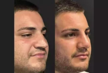 Nose Job in Dubai