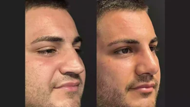Nose Job in Dubai