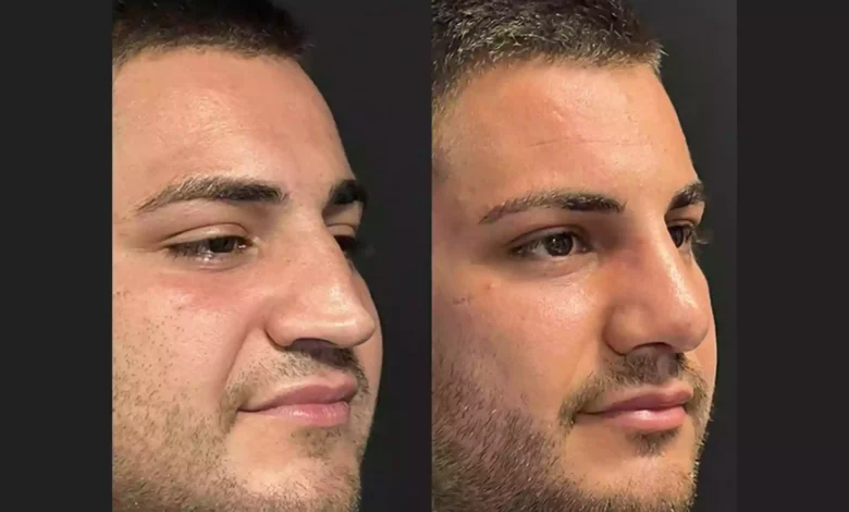Nose Job in Dubai